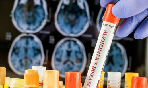 Organoidi cerebrali per la ricerca sull'Alzheimer